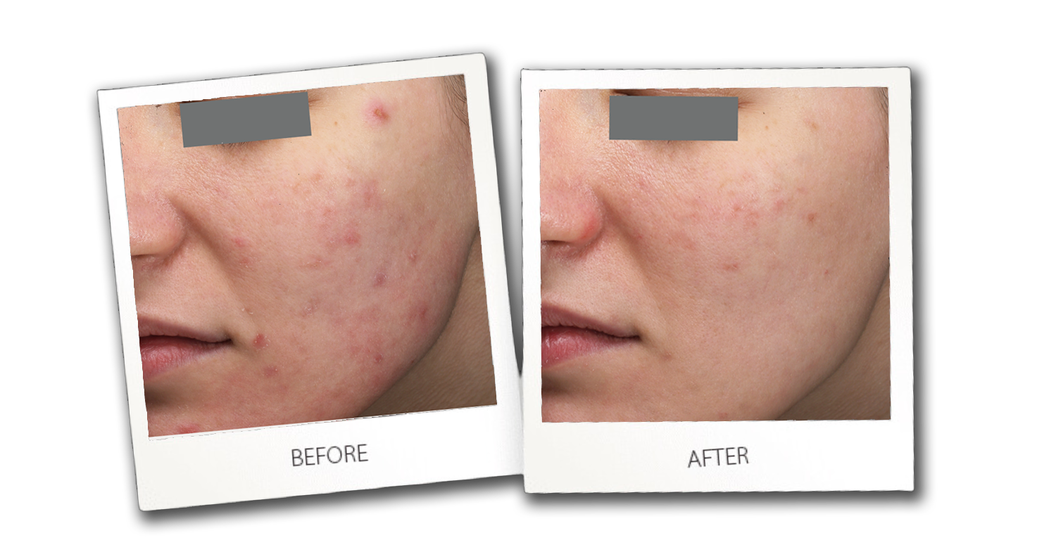 before and after Candela Facial Results