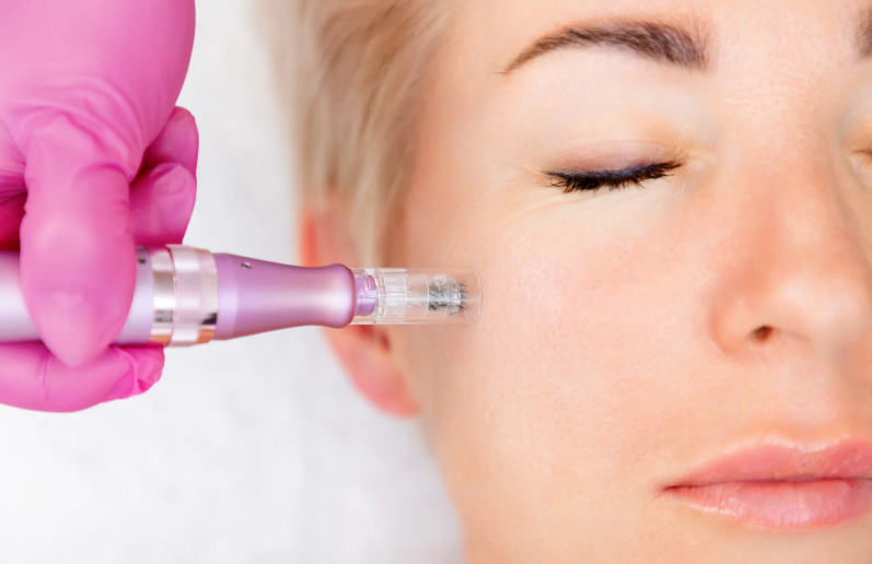microneedling